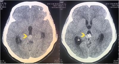 Case report: Implantation metastasis following stereotactic biopsy of pineal parenchymal tumor of intermediate differentiation in an adult patient: An exceptionally rare complication